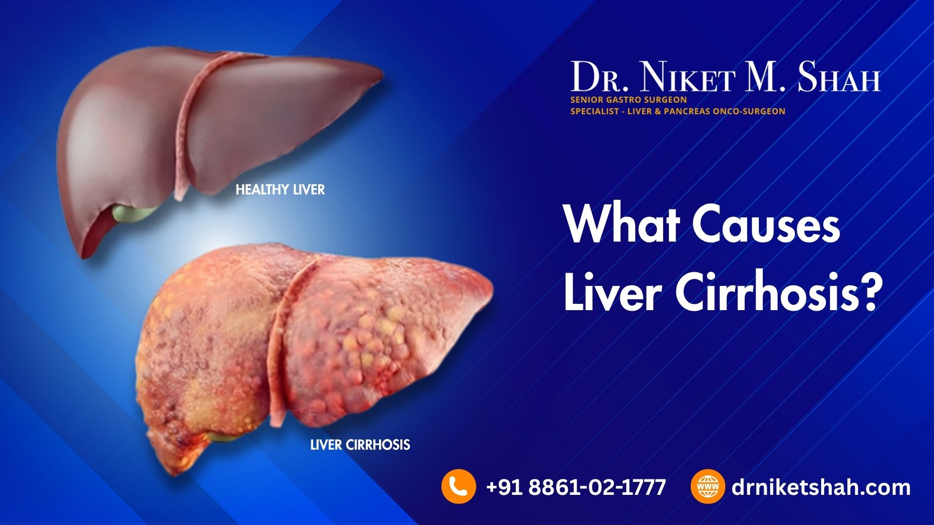 What causes liver cirrhosis?